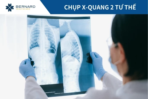 Chụp X-quang 2 tư thế